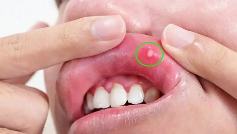 Vücudunuzdaki B Vitamini Eksikliğini Görmenizi Sağlayacak 5 Belirgin İşaret