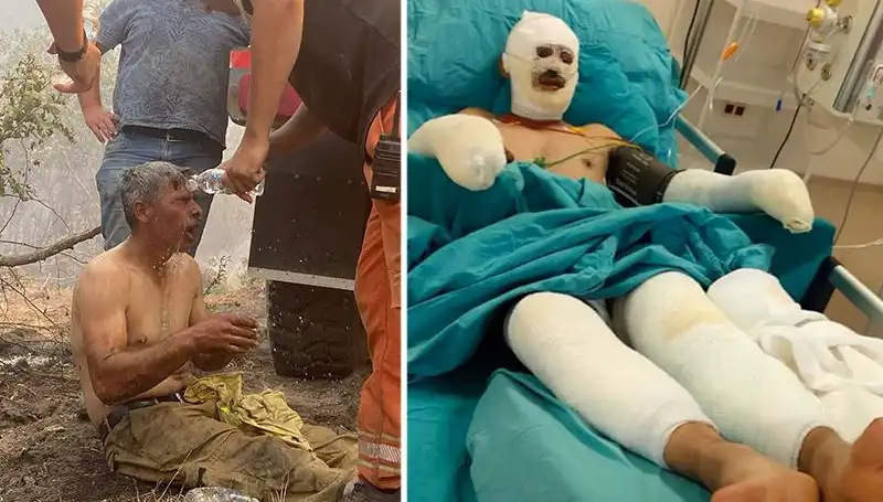 Orman İşçisinin Yanık Tedavisi: Yaşadığı Korkunç Anlar ve Süreç